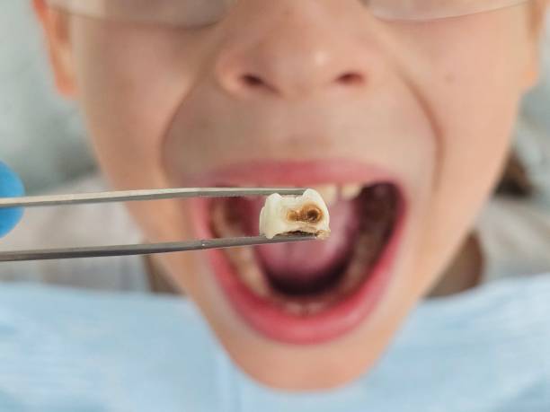 Best Emergency Dental Care for Broken or Chipped Teeth in Emerald Bay, TX